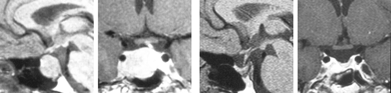MRI Showing Tumor Reduction Dopamine Agonist